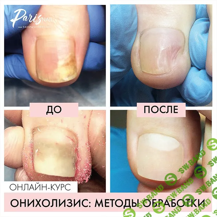 [Карина Шурыгина] Онихолизис: методы обработки (2018)