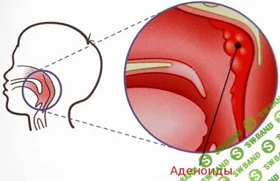 [Леднева Елена] Аденоиды казнить нельзя помиловать.