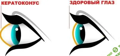 [Людмила Лазарева] Убираем кератоконус. Возвращаем нормальную форму глаз (2023)