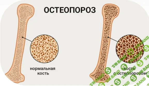Остеопороз - что необходимо знать эндокринологу. Часть 1. Диагностика [Pro et Contra] [Светлана Мирная]