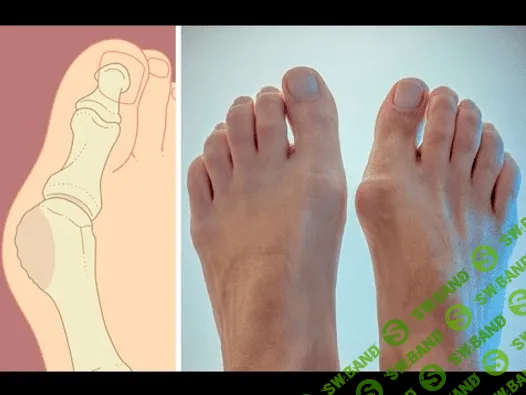 Секреты антикосточки и греческой стопы - Маматов (2017)